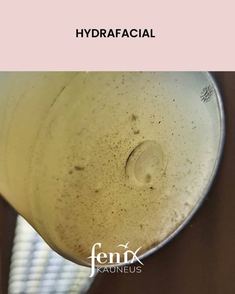 HydraFacial-sailion sisaltoa lahikuvassa, sailion pohjasta pain kuvattuna. Ihosta imetyt epapuhtaudet lilluvat sailiossa olevan hoitonesteen seassa.