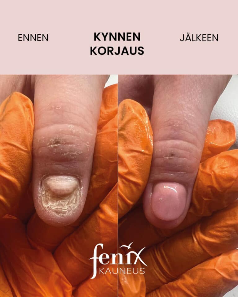 Rikkinainen murentunut peukalonkynsi, joka on korjattu ehjaksi geelikynnella.