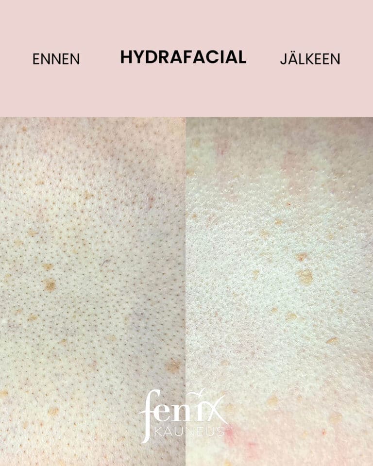 Lahikuva selan ihohuokosista ennen ja jalkeen HydraFacial-hoidon. Ennen-kuvassa nakyy paljon mustapaita ja jalkeen-kuvassa mustapaat ja epapuhtaudet ovat poissa.
