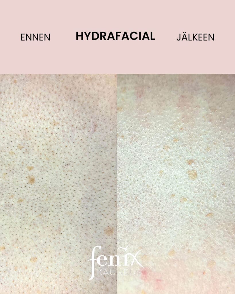 Lahikuva selan ihohuokosista ennen ja jalkeen HydraFacial-hoidon. Ennen-kuvassa nakyy paljon mustapaita ja jalkeen-kuvassa mustapaat ja epapuhtaudet ovat poissa.