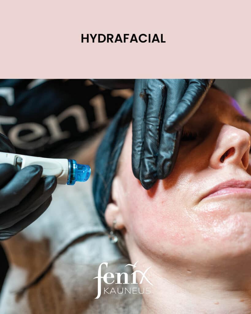 Posken ihoa lahikuvassa HydraFacial-hoidon aikana.