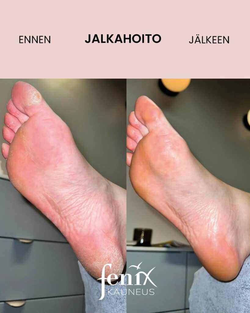 Kovettumainen ja kuiva jalkapohja ennen ja jalkeen jalkahoidon. Ero lopputuloksessa on huomattava.