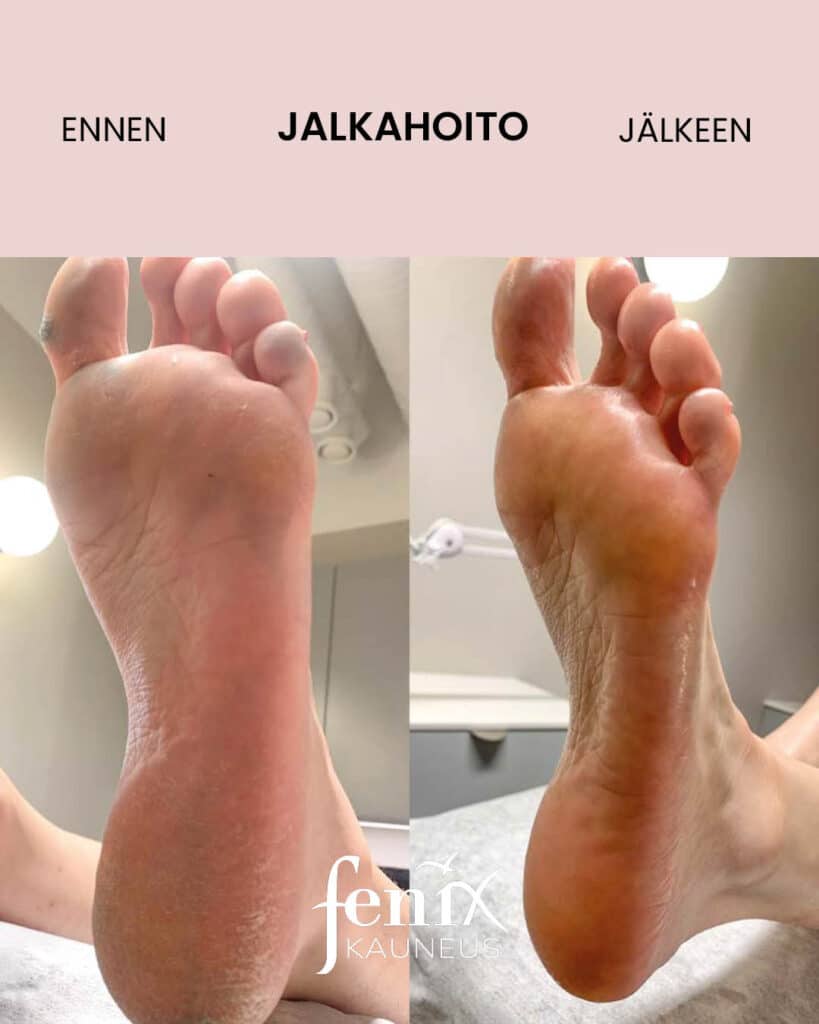 Kuiva ja kovettumainen jalkapohja ennen ja jalkeen jalkahoidon. Ero on huomattava.