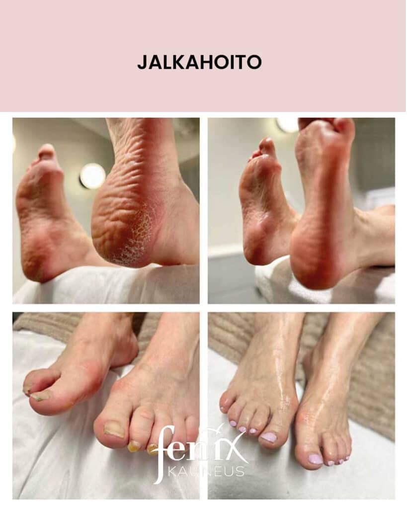 Ennen ja jalkeen -kuvat kuivista kantapaista ja ylipitkaksi kasvaneista kynsista, jotka on jalkahoidolla hoidettu kuntoon ja lopuksi kynnet on lakattu vaaleanliloiksi.