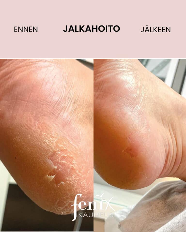 Ennen ja jalkeen -kuva kuivasta ja lohkeilleesta kantapaan ihosta, joka on jalkahoidolla saatu huomattavasti parempaan kuntoon.