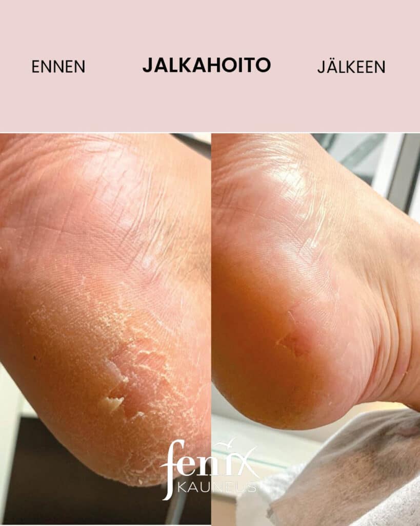 Ennen ja jalkeen -kuva kuivasta ja lohkeilleesta kantapaan ihosta, joka on jalkahoidolla saatu huomattavasti parempaan kuntoon.
