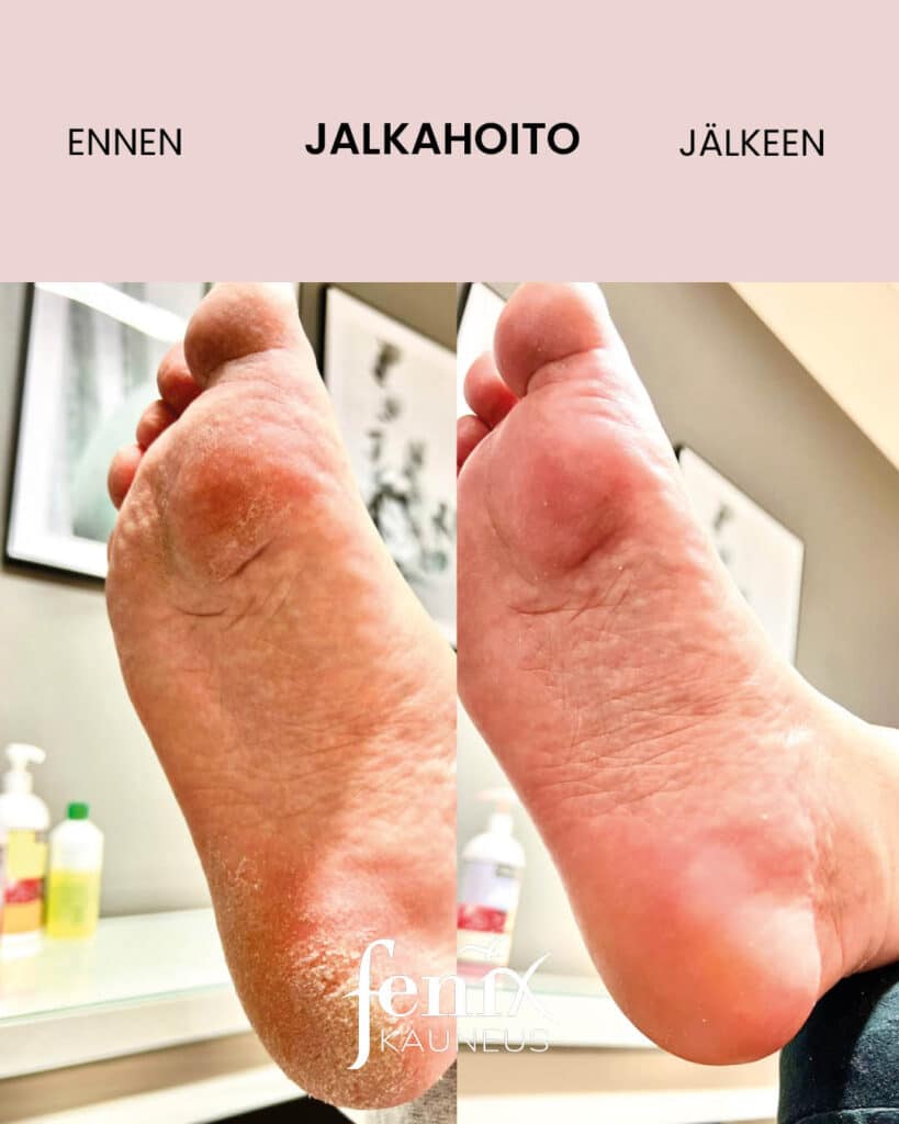 Kovettumainen kantapaa ja kuiva jalkapohja ennen ja jalkeen jalkahoidon. Lopputulos on kirjaimellisesti kasin kosketeltava.