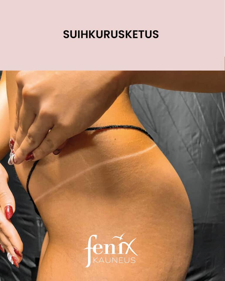 Rusketusrajat bikinilinjassa suihkurusketuksen jalkeen.