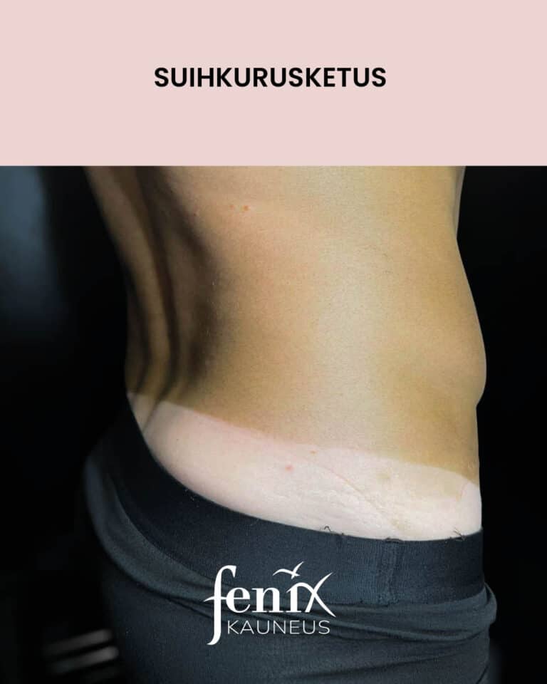 Rusketusrajat bokserin alla suihkurusketuksen jalkeen.