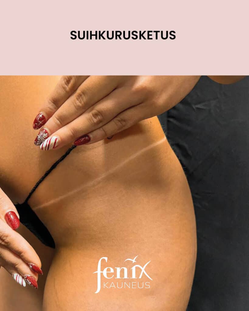 Rusketusrajat bikinilinjassa suihkurusketuksen jalkeen.