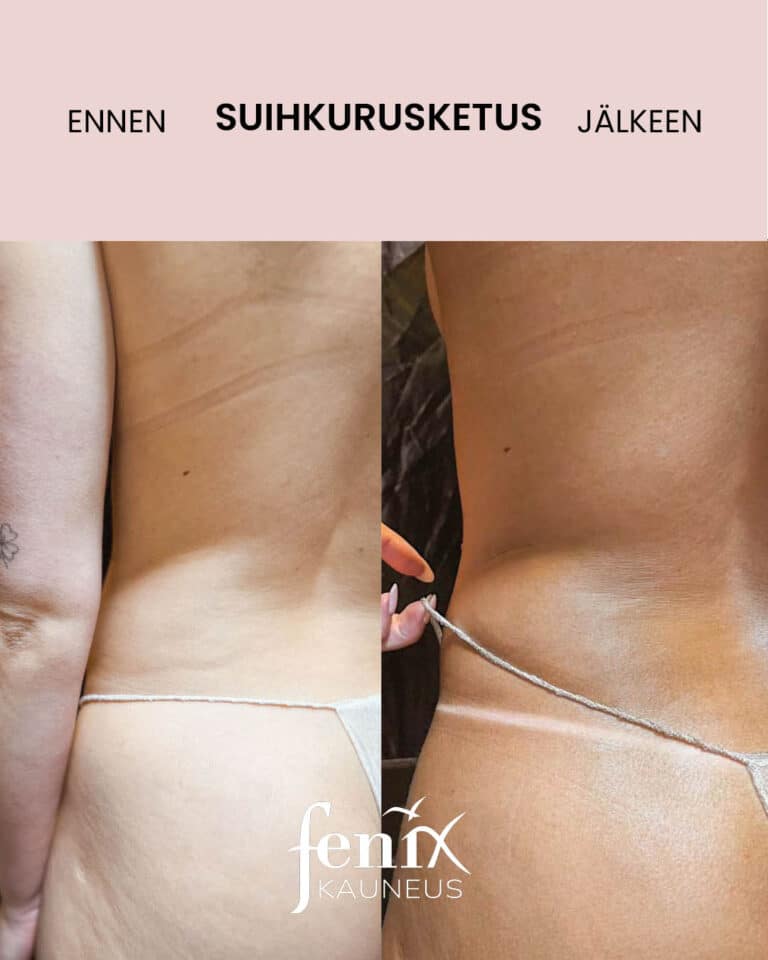 Vartalo ennen ja jalkeen suihkurusketuksen.