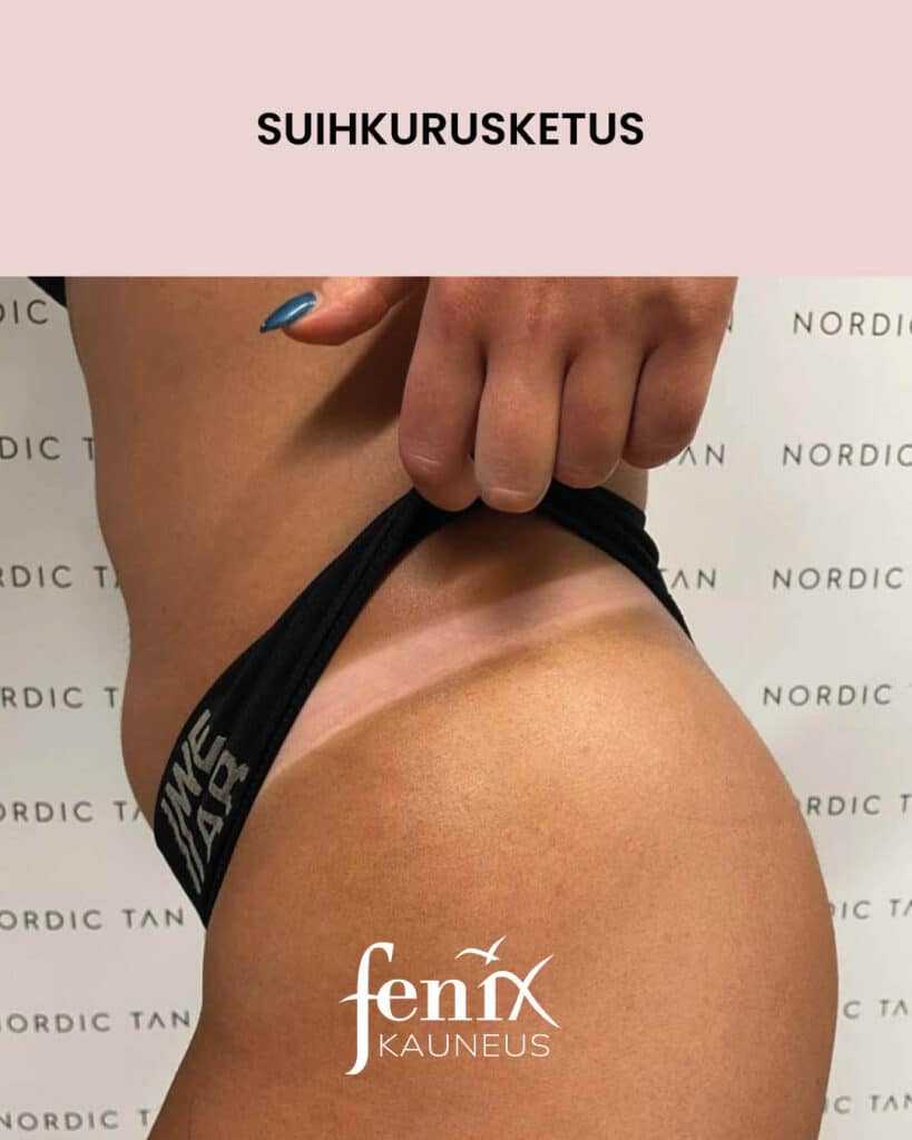 Nordic Tan -rusketusrajat bikinilinjassa suihkurusketuksen jalkeen.