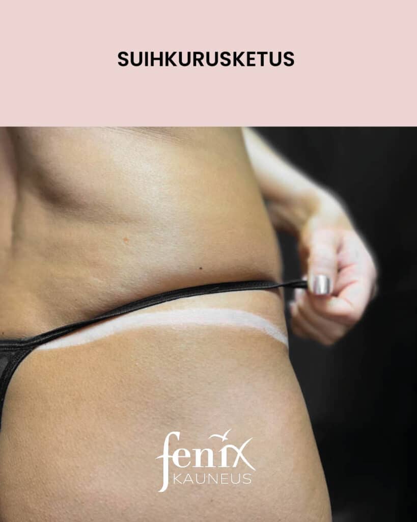 Rusketusrajat vartalolla suihkurusketuksen jalkeen.