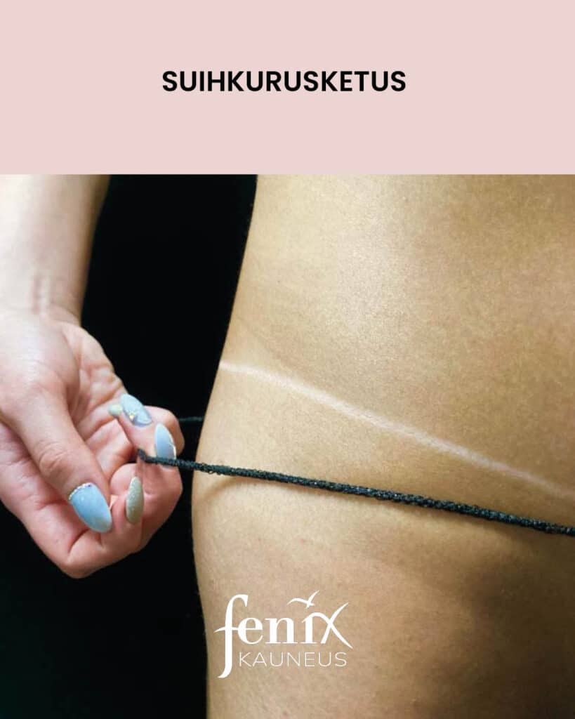 Rusketusrajat alushousujen kohdalla suihkurusketuksen jalkeen.