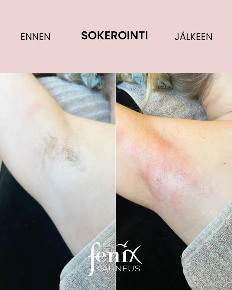 Kainalo ennen ja jalkeen ihokarvojen sokeroinnin.