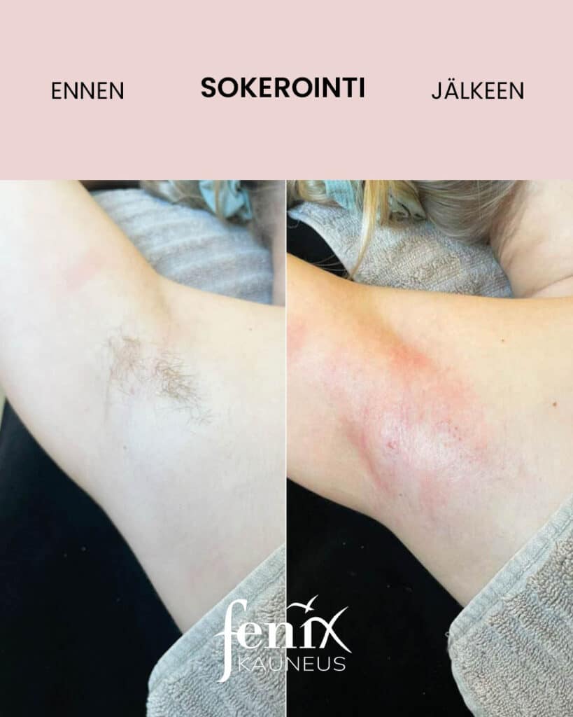 Kainalo ennen ja jalkeen ihokarvojen sokeroinnin.