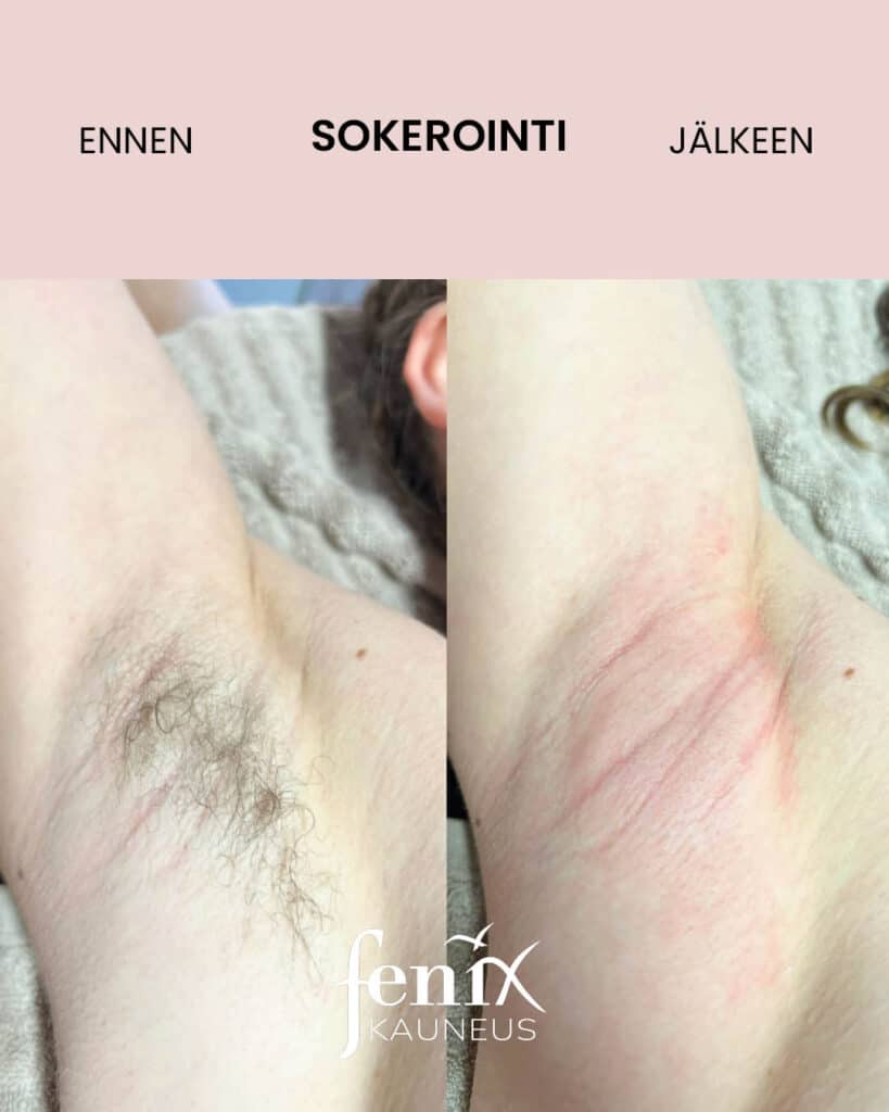 Kainalo ennen ja jalkeen kainalokarvojen sokeroinnin.