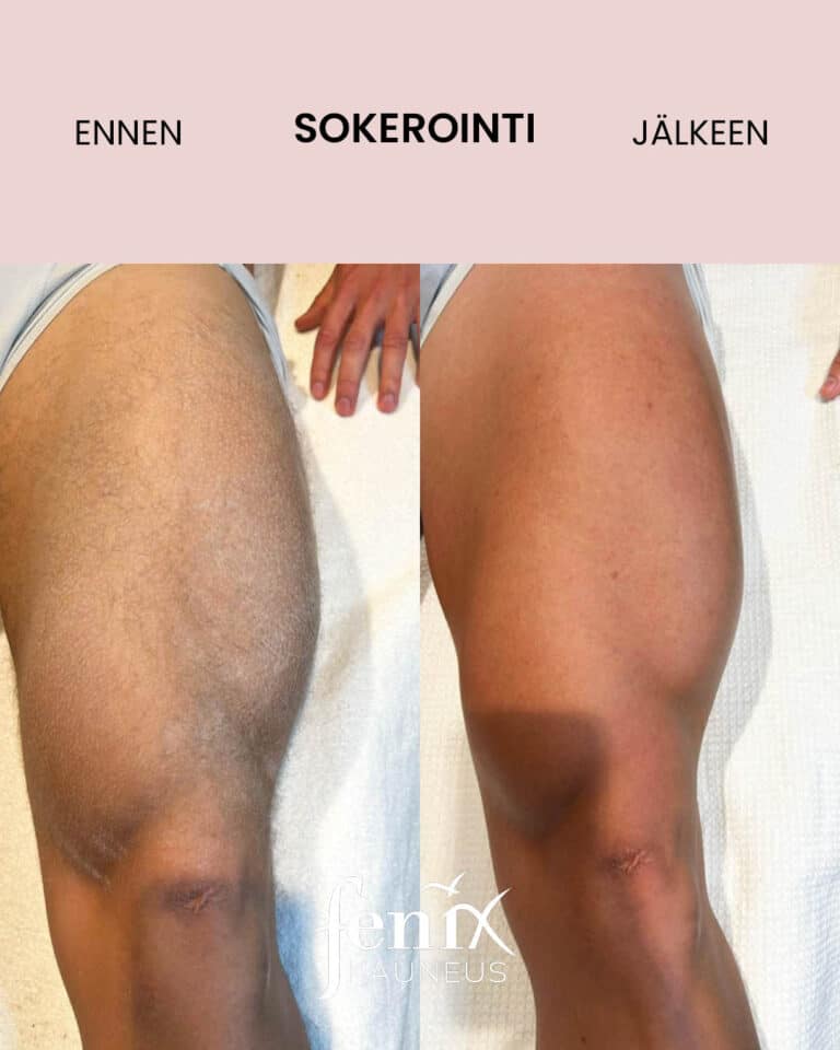 Lihaksikas miehen reisi ennen ja jalkeen ihokarvojen sokeroinnin.