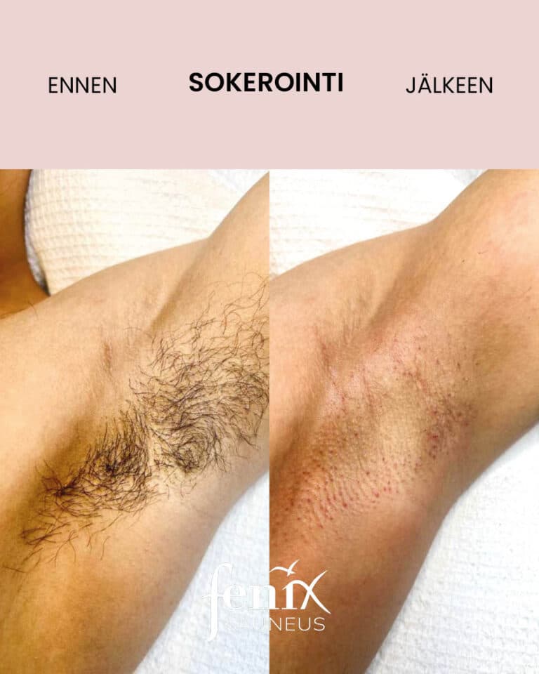 Miehen kainalo ennen ja jalkeen kainalokarvojen sokeroinnin.