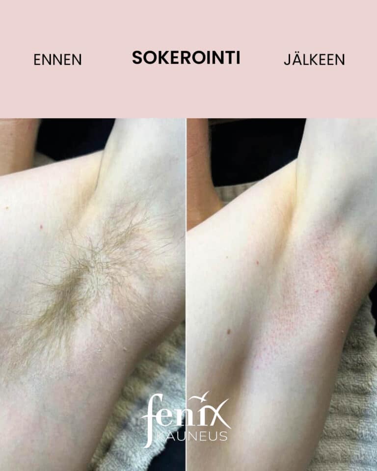 Miehen kainalo ennen ja jalkeen ihokarvojen sokeroinnin.