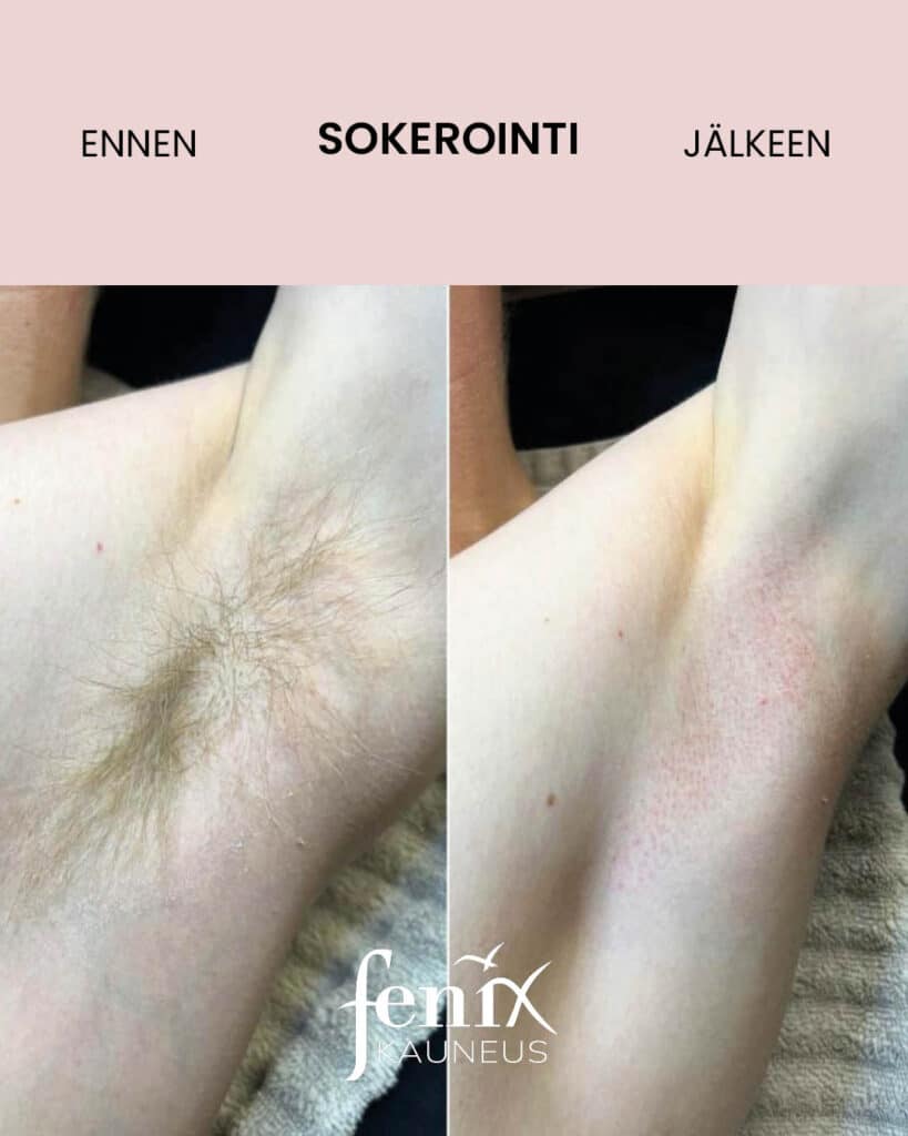 Miehen kainalo ennen ja jalkeen ihokarvojen sokeroinnin.