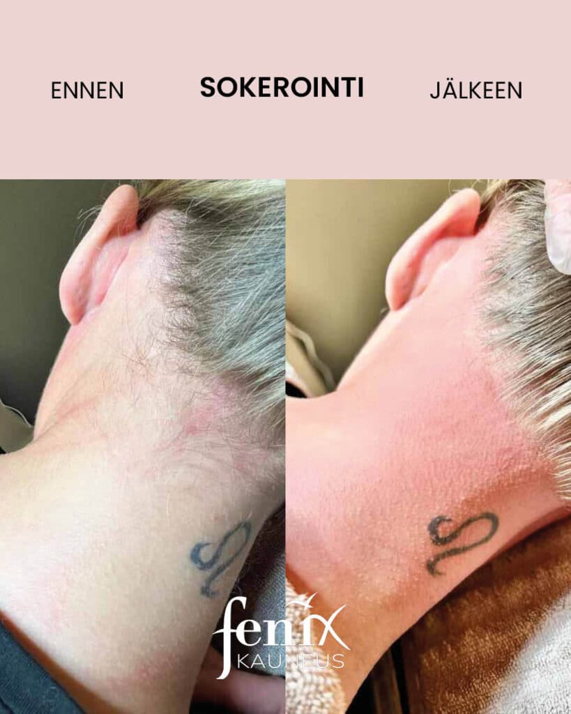 Naisen niskavillat ennen ja jalkeen sokeroinnin.