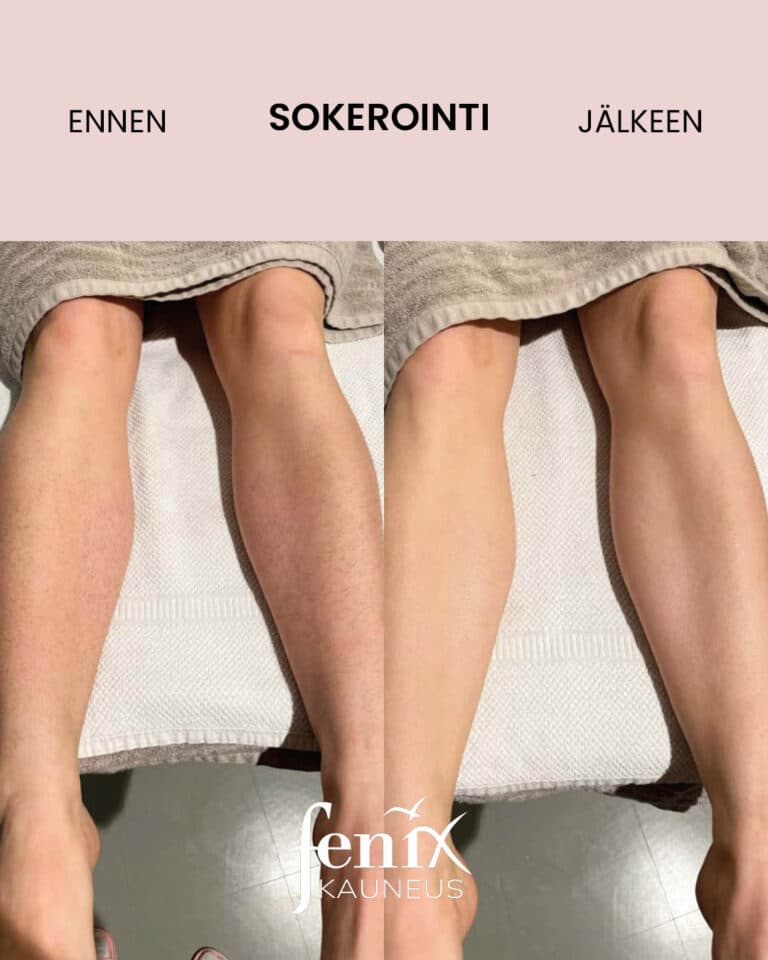 Naisen saaret ennen ja jalkeen saarikarvojen sokeroinnin.