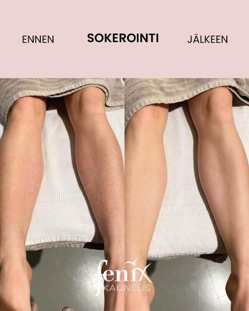 Naisen saaret ennen ja jalkeen saarikarvojen sokeroinnin.