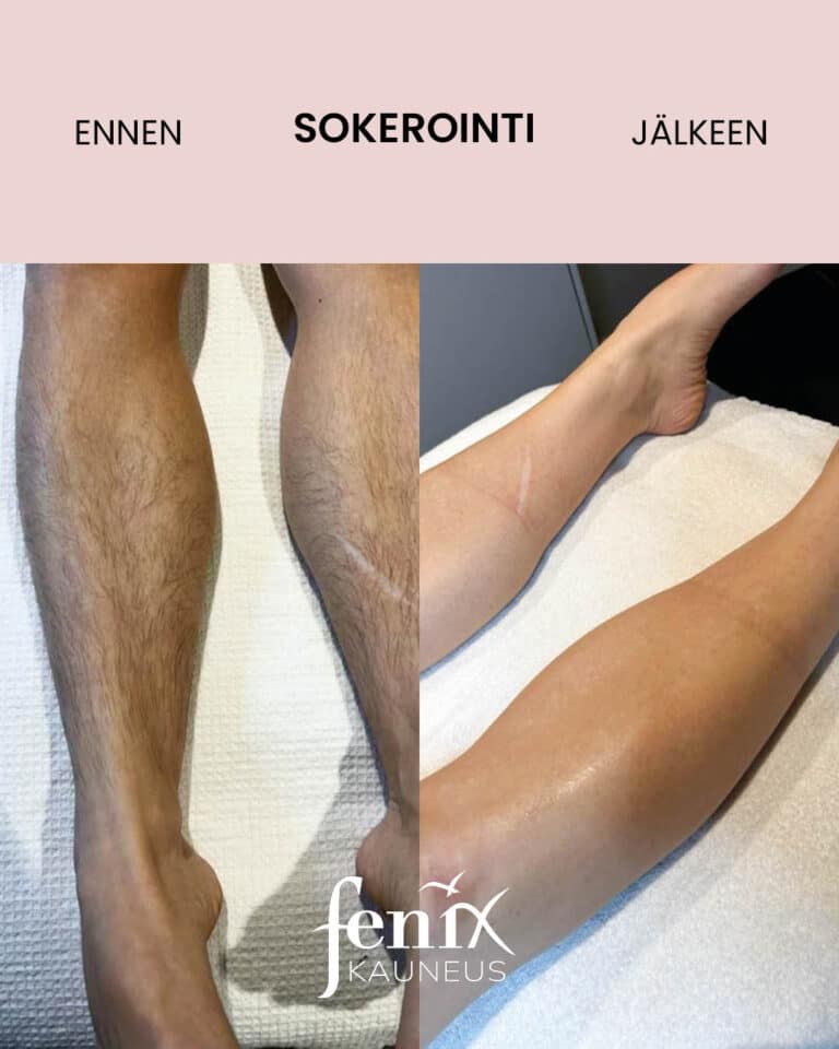 Saarten ihoa ennen ja jalkeen saarikarvojen sokerointia.