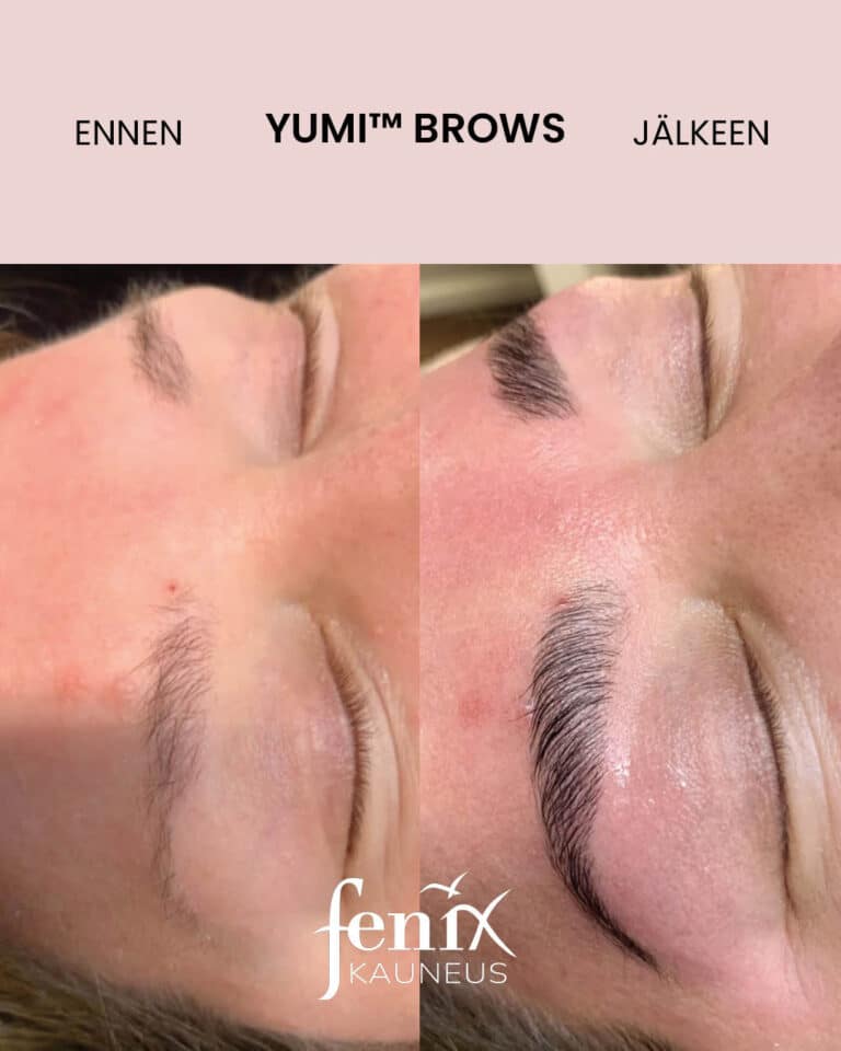 Tummat kulmakarvat ennen ja jalkeen YumiBrows kulmakarvojen laminointihoidon.