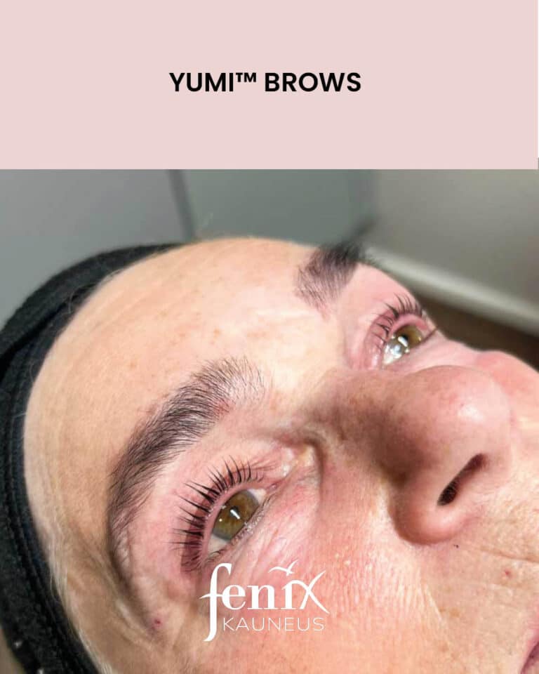 Kulmakarvat YumiBrows brow liftin jalkeen.