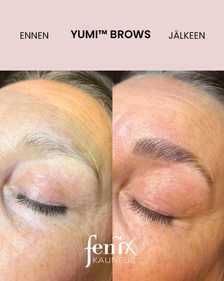 Aikuisen henkilön kulmakarvat ennen ja jalkeen YumiBrows kulmakarvojen laminointihoidon.