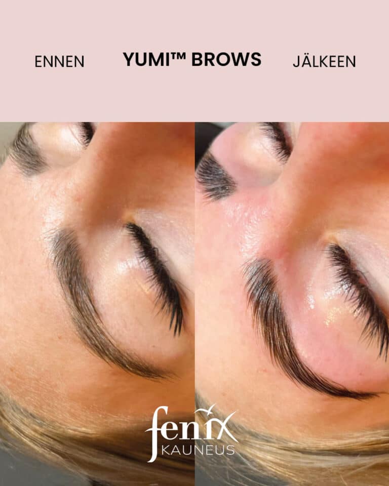 Nuoren naisen kulmakarvat enne ja jalkeen YumiBrows kulmakarvojen laminointihoidon.
