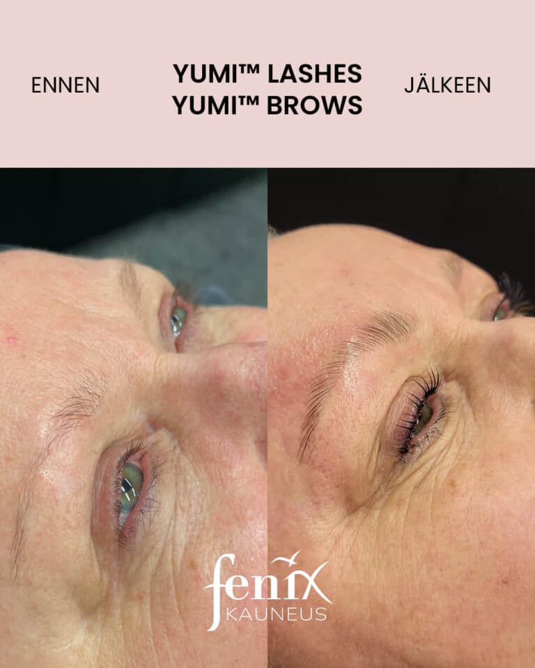 Yumi kombo ennen ja jalkeen aikuisella naisella.