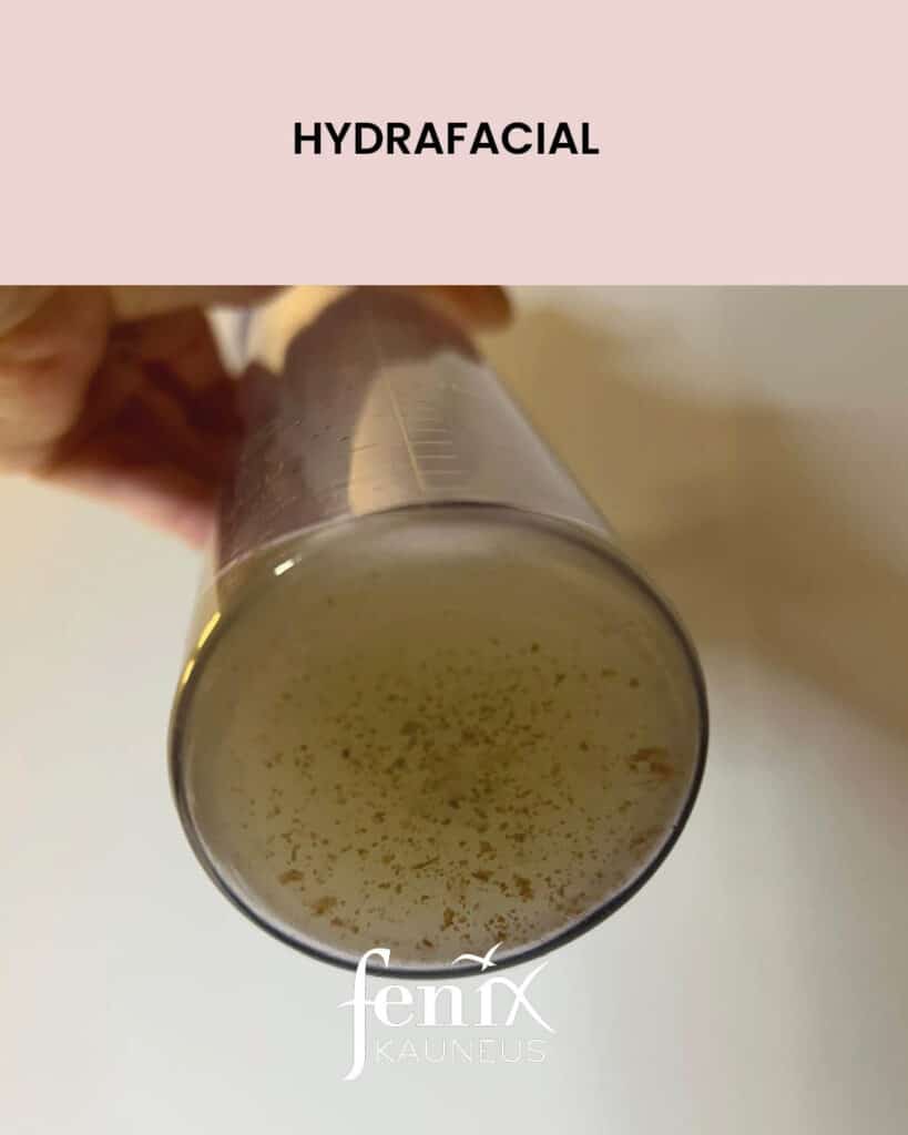 HydraFacial Clarifying-hoidossa ihosta irronneita epäpuhtauksia sailiossa
