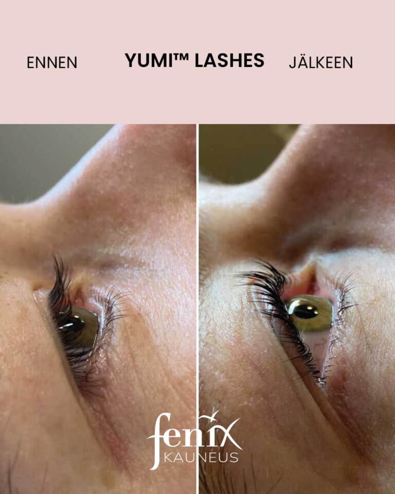 Yumilashes kuva sivustapain ennen ja jalkeen.