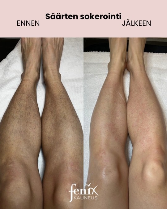 Saarten sokerointi ennen ja jalkeen hoidon.