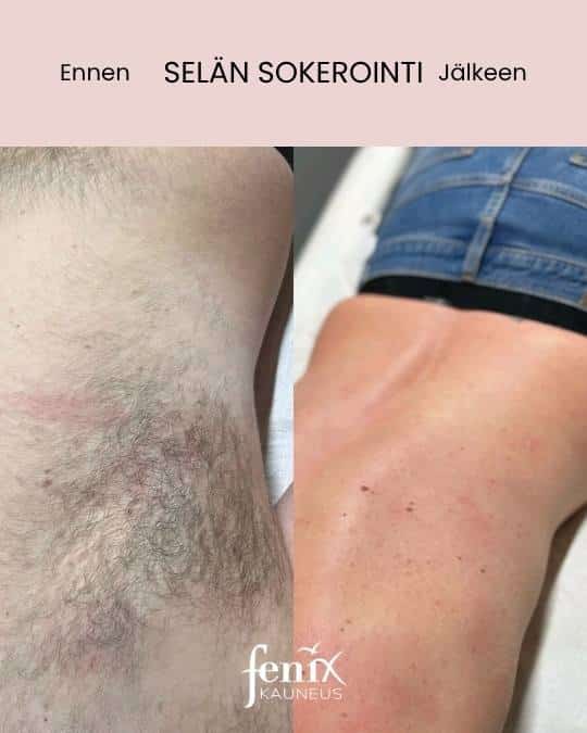 Ennen ja jalkeen miesten selan sokeroinnin.