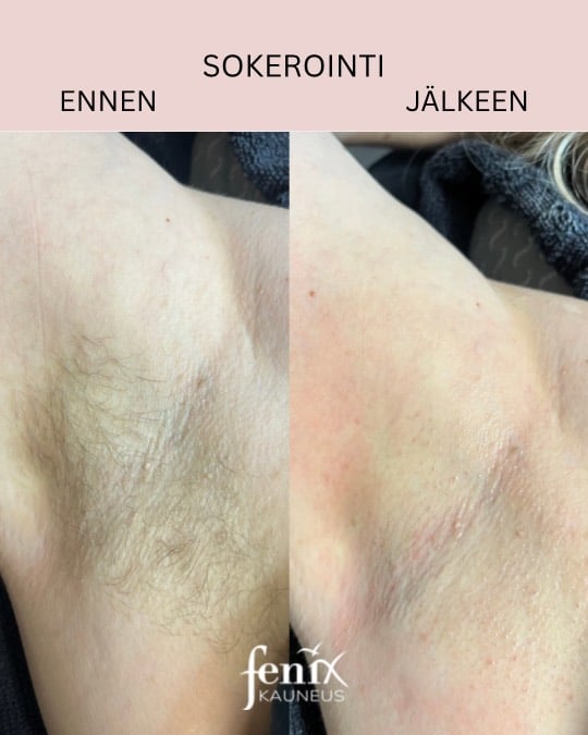 Kainalo sokerointi ennen ja jalkeen.