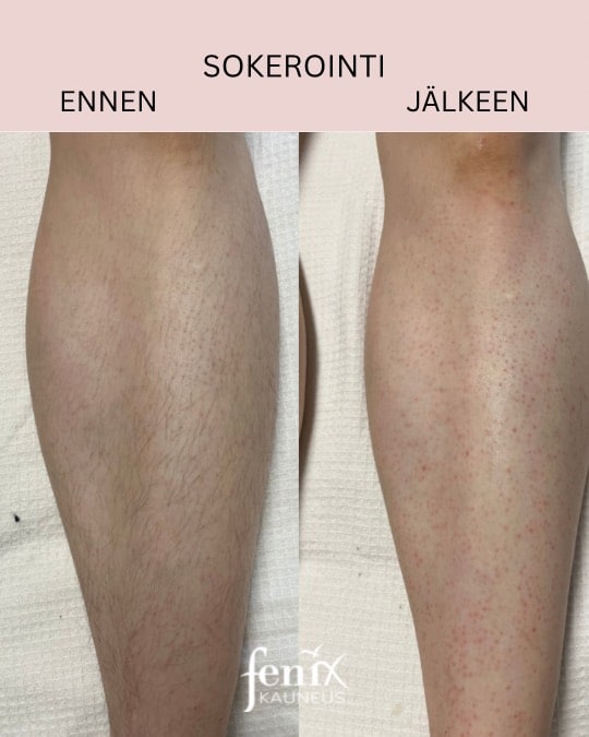 Saarten sokerointi ennen ja jalkeen.