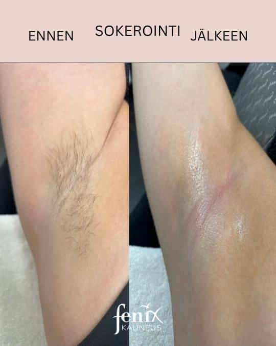 Kainaloiden sokerointi ennen ja jalkeen.