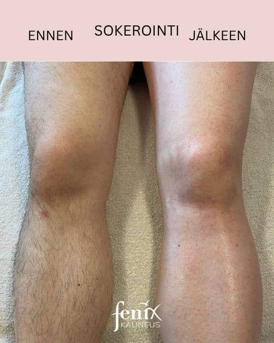 Saarten sokerointi ennen ja jalkeen.