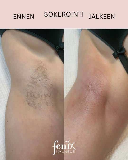 Kainalon sokerointi ennen ja jalkeen.