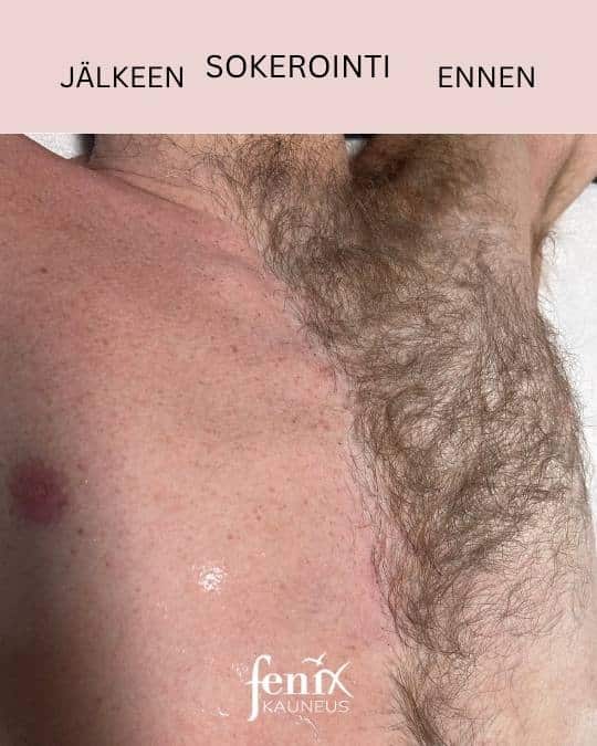 Rinnan sokerointi miehelta ennen ja jalkeen.