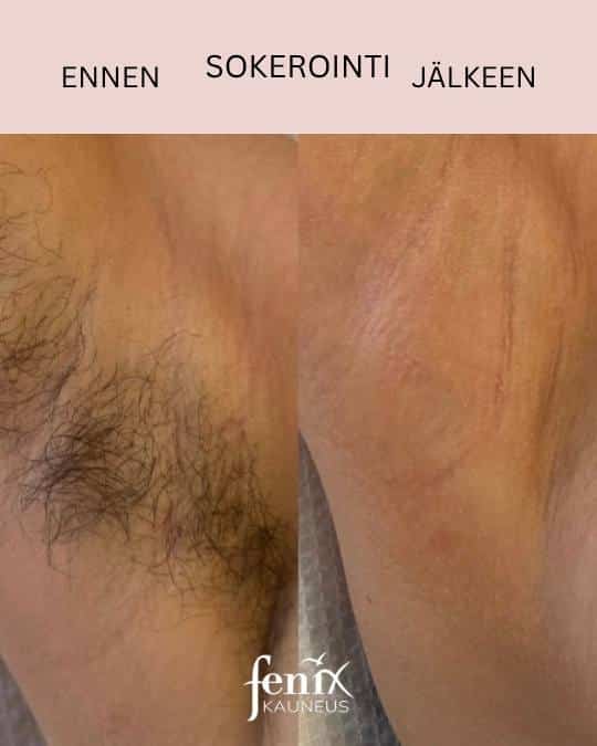 Kainaloiden sokerointi ennen ja jalkeen.