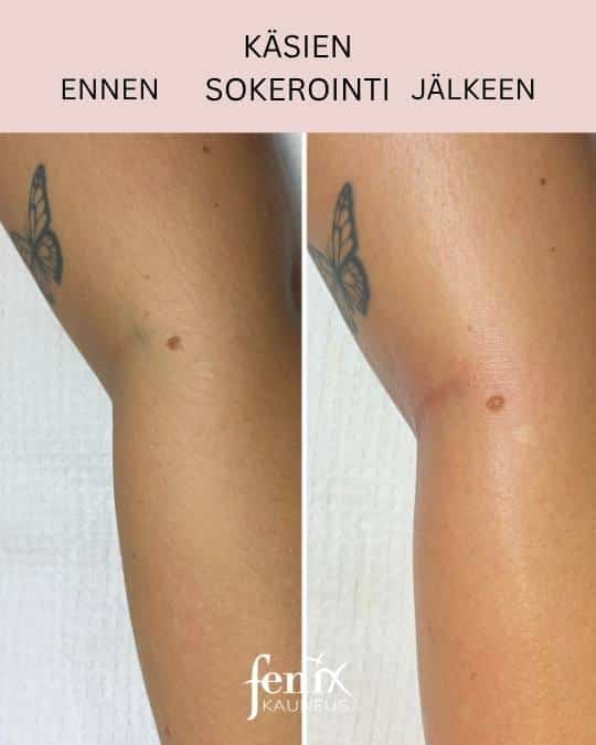 olkavarsi sokerointi ennen ja jalkeen.