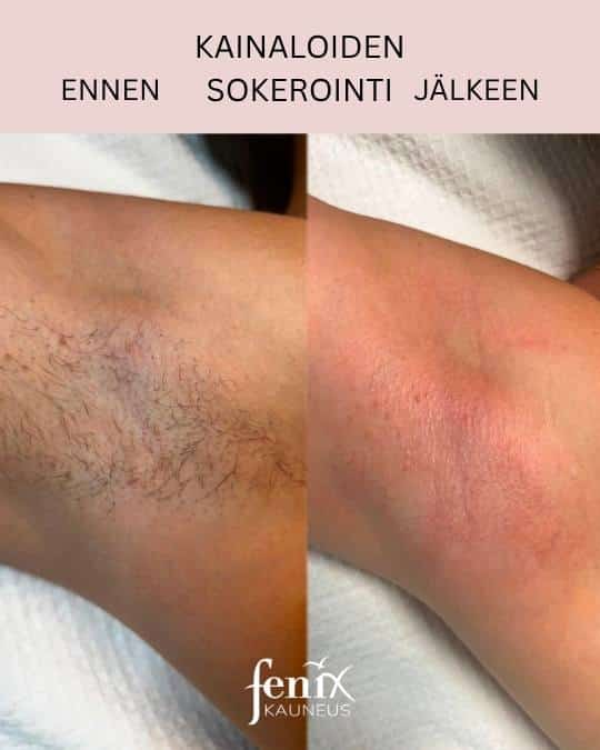 kainaloiden ennen ja jalkeen sokerointi.