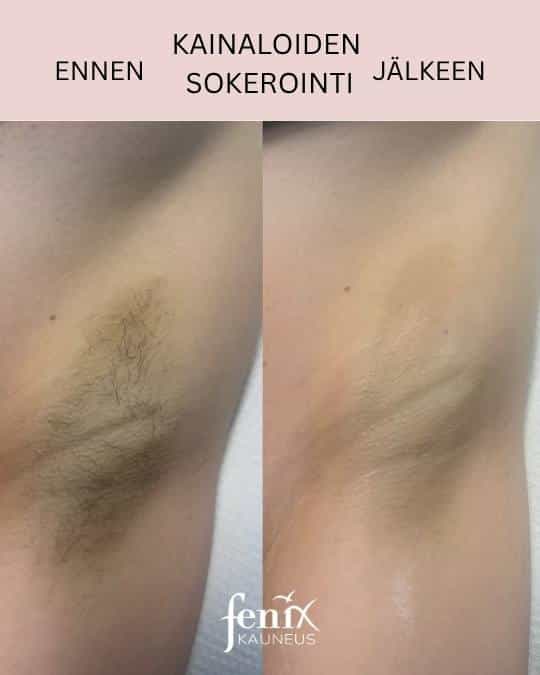 sokerointi kainaloon ennen ja jalkeen.