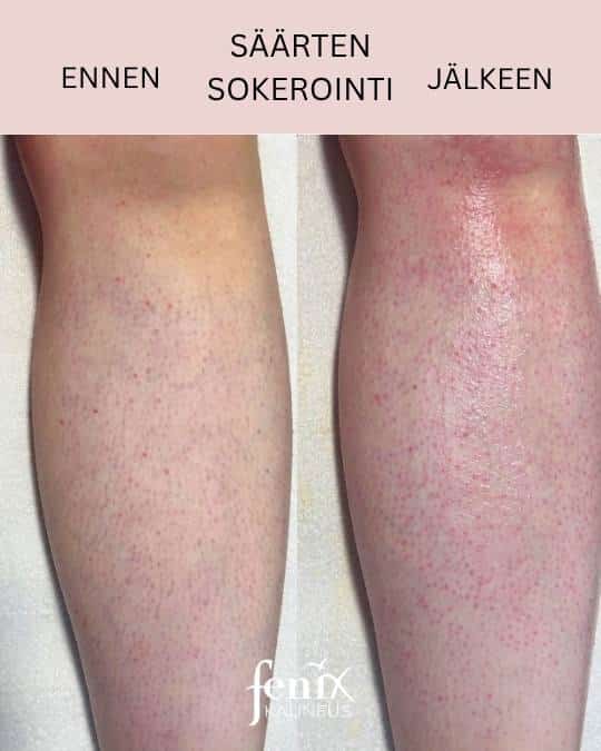 Saarten sokerointi